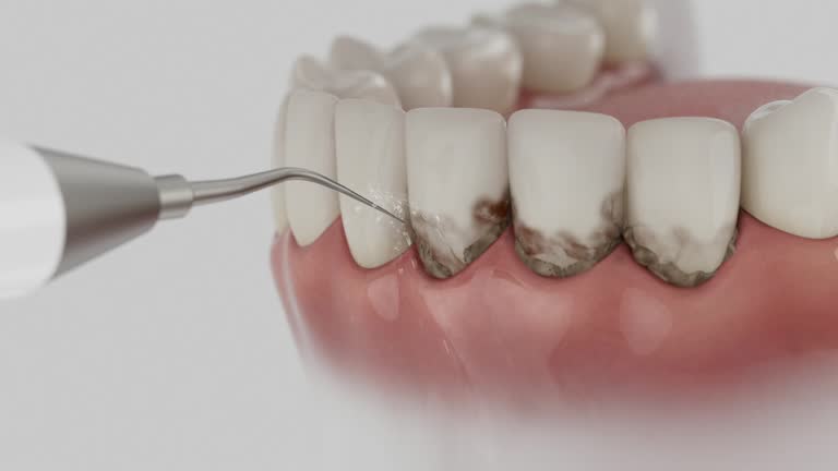 Trusted Wisdom Tooth Removal service in Montesano, WA - Dentist Open Now
